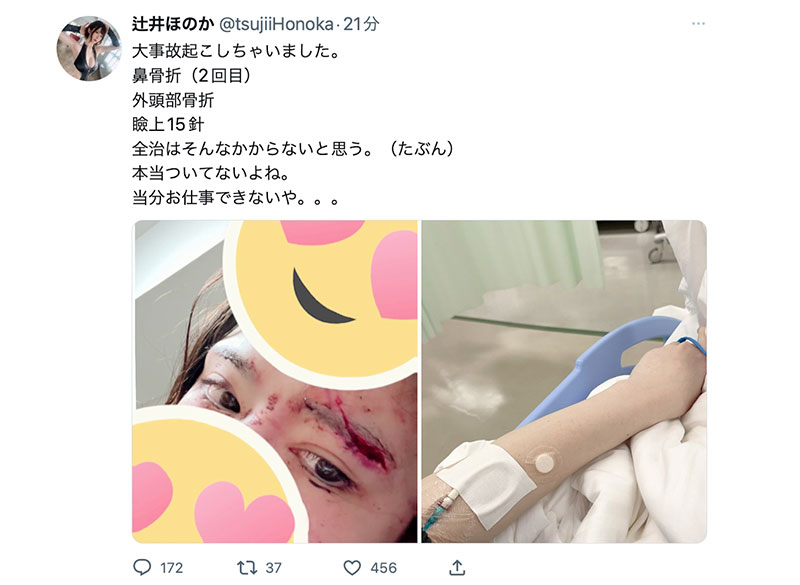 鼻子骨折眼皮缝了15针！辻井ほのか(辻井穗乃果)重伤破相！